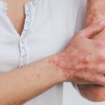 5 ting du skal kunne hvis du går op i psoriasis