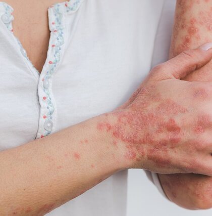 5 ting du skal kunne hvis du går op i psoriasis